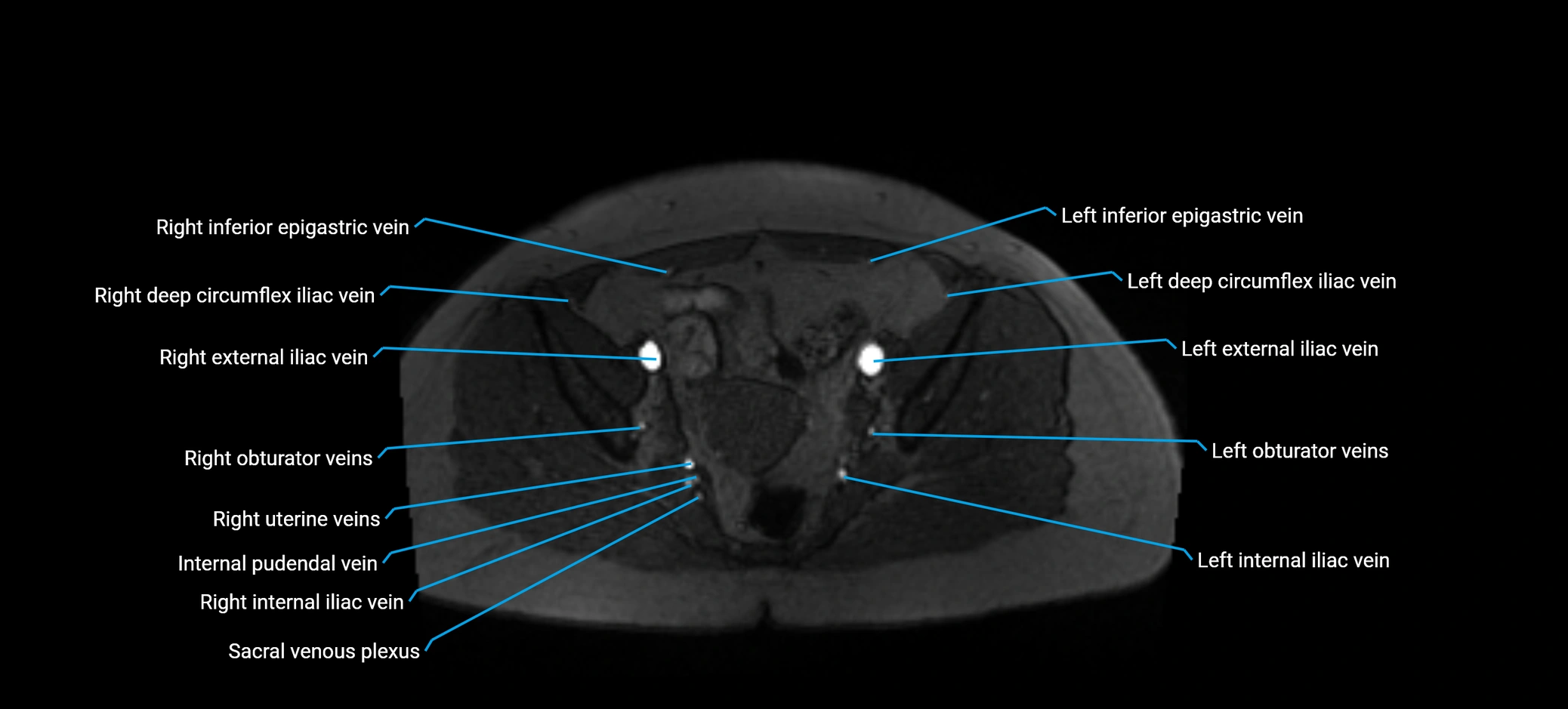 MRV abdomen pelvis & lower limb axial cross sectional anatomy labelled MRI image 158 (1).webp
